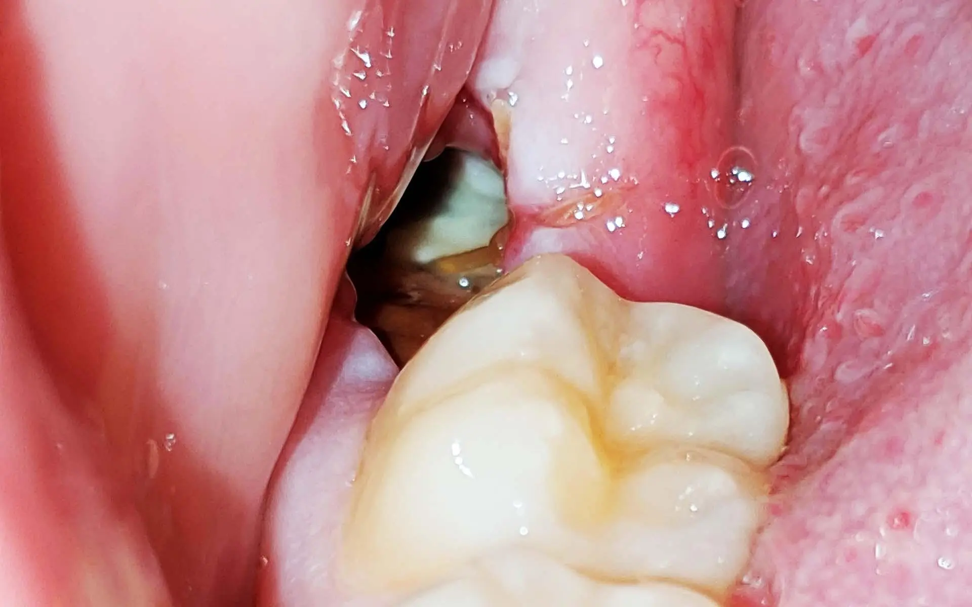 Dry Socket