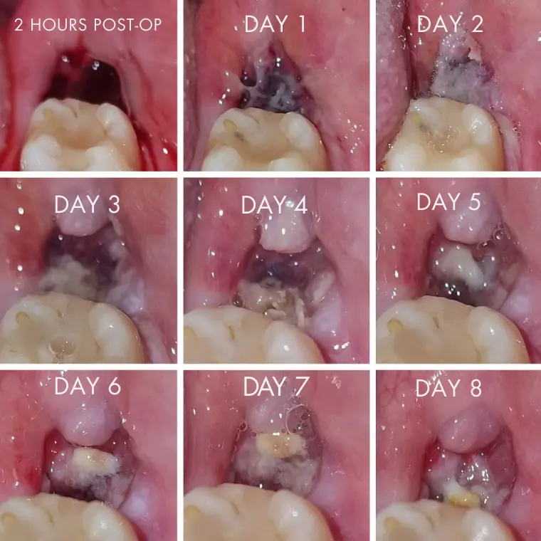 What Is the Healing Timeline for a Normal Socket